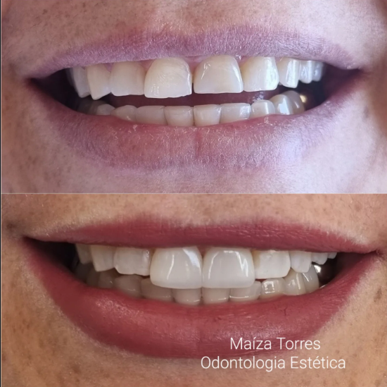 Antes e depois — Dra. Maíza Torres