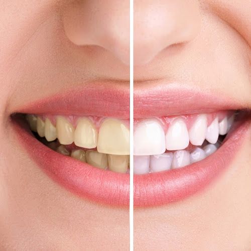 Clareamento Dental
