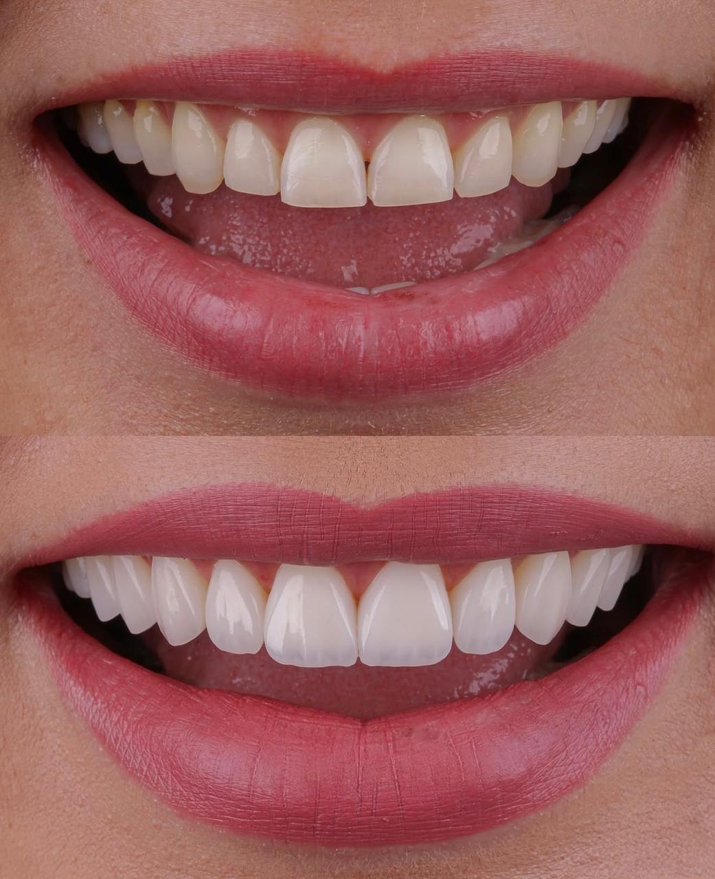 Facetas em Resina e Porcelana